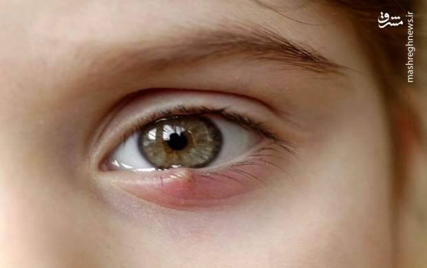کودک نابینا بعد از یک سال مادرش را دید