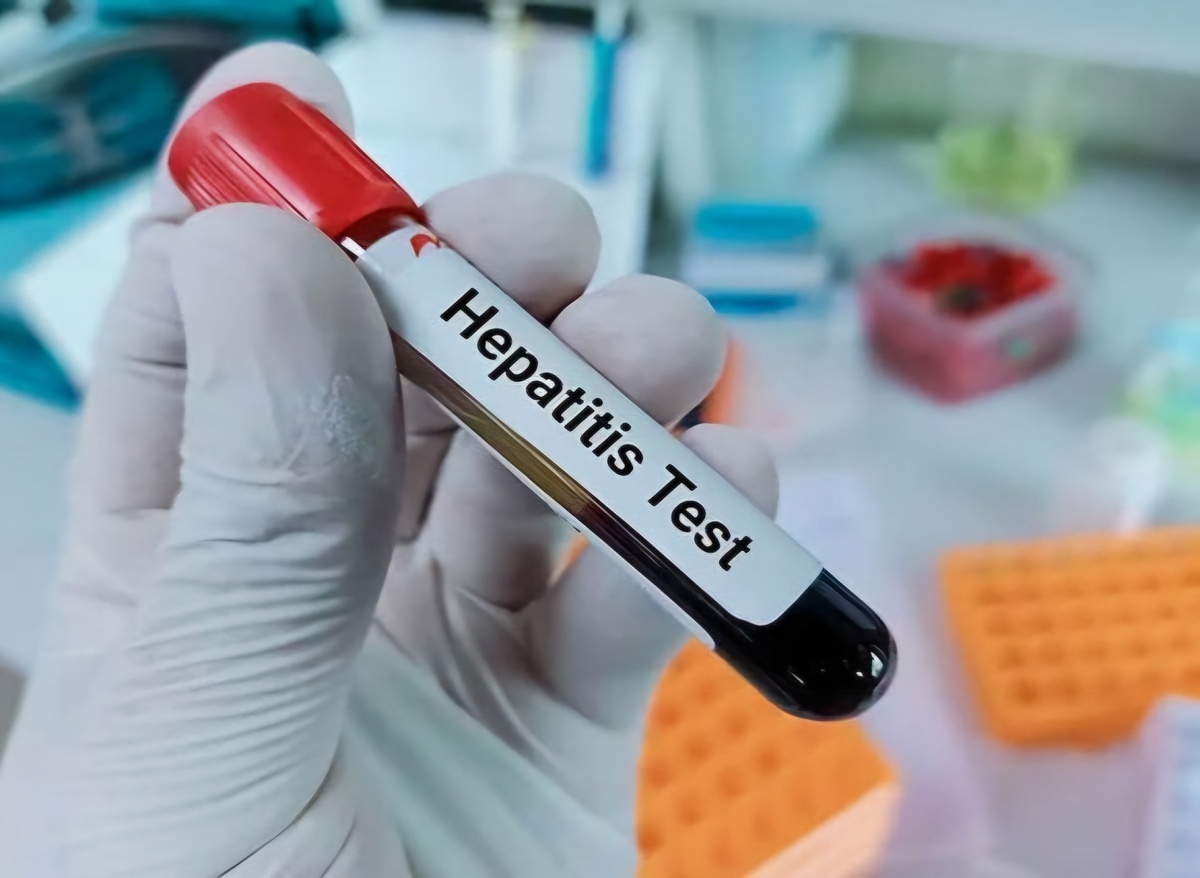 هپاتیت چگونه منتقل میشود؟ راههای پیشگیری از آن چیست؟ هپاتیت چگونه منتقل میشود؟ راههای پیشگیری از آن چیست؟