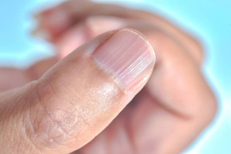 علت شیارهای روی ناخن چیست؟ علت شیارهای روی ناخن چیست؟
