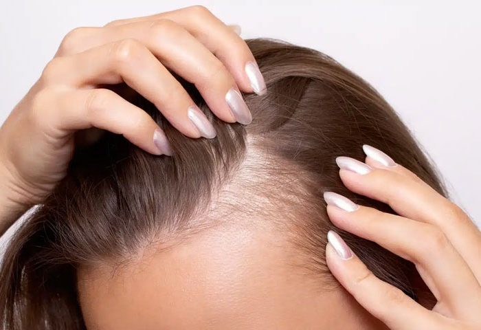 نقش هورمونها و ژنتیک در ریزش مو و تأثیر آن بر موفقیت کاشت نقش هورمونها و ژنتیک در ریزش مو و تأثیر آن بر موفقیت کاشت