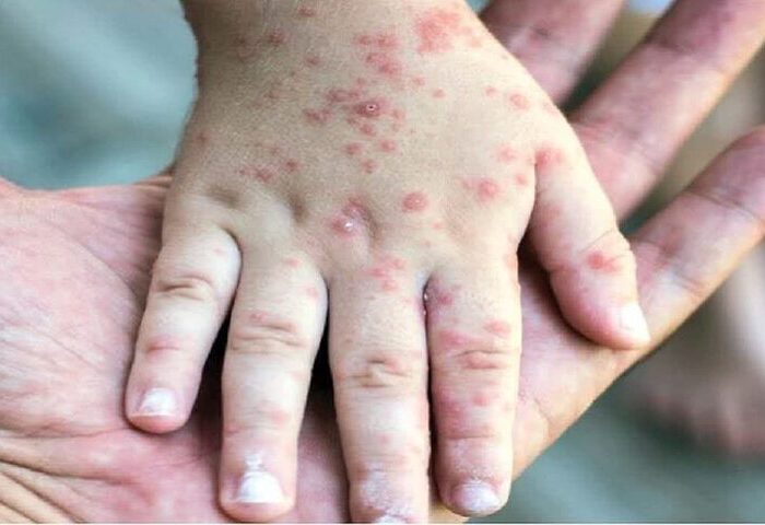 ثبت ۷۱۴ مورد «سرخک» در کشور؛ اوج ابتلا در اردیبهشت