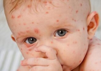 شیوع «آبله مرغان» در بهار